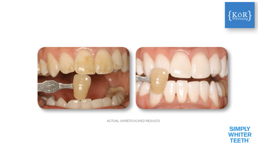 Kor Teeth Whitening at Ware Family Dentistry